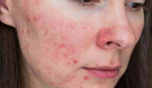Fungal Acne Treatment at Home: Effective Remedies for Clear Skin